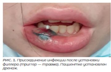 Топ-5 самых опасных процедур красоты с точки зрения заражения ВИЧ-инфекцией